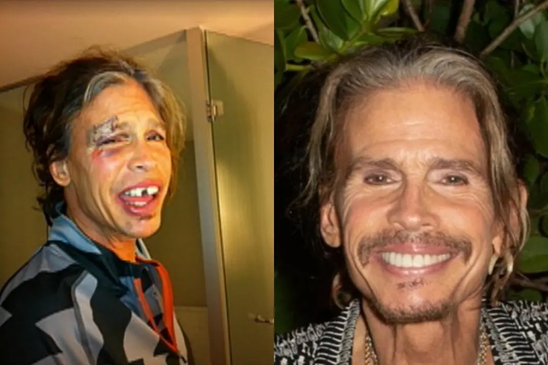 Steven Tyler dental implant before after