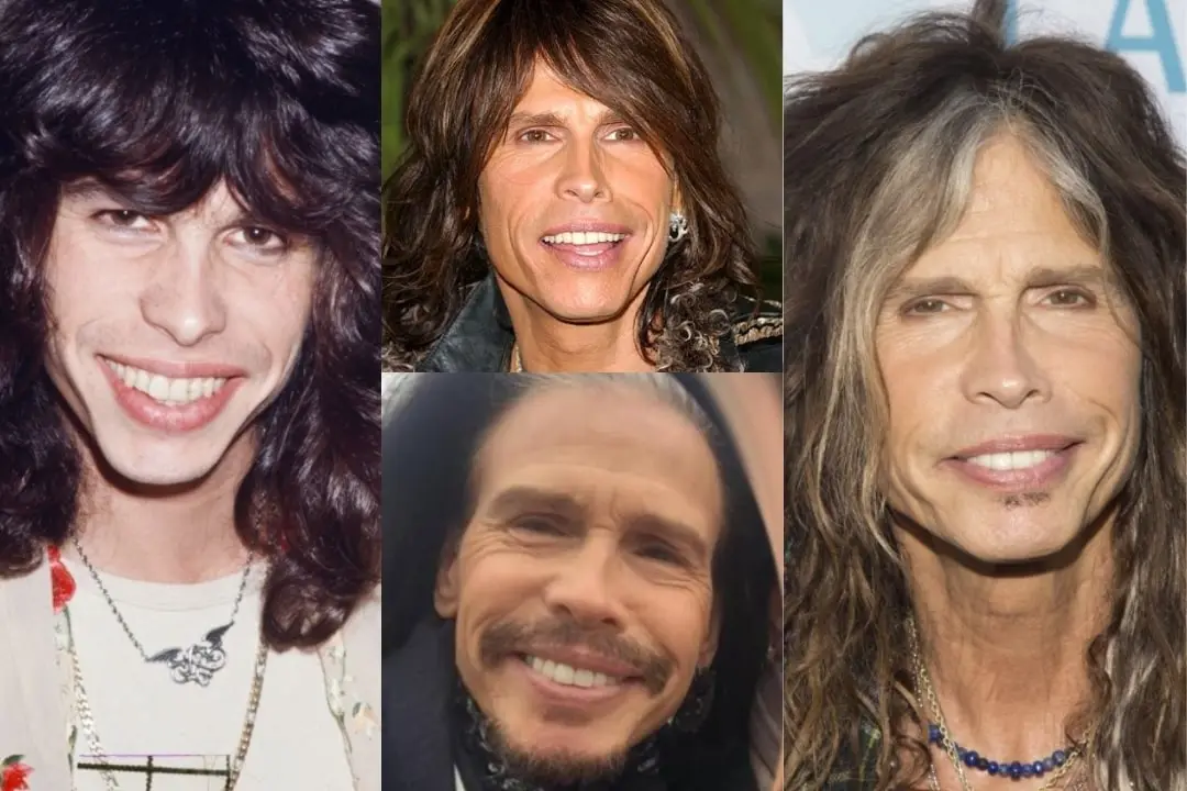 Steven Tyler dental implant before after