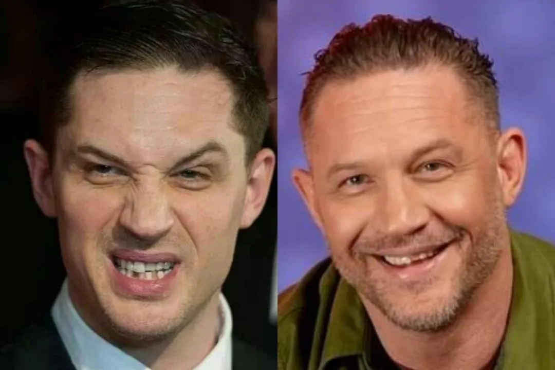 What dental problems did Tom Hardy have?