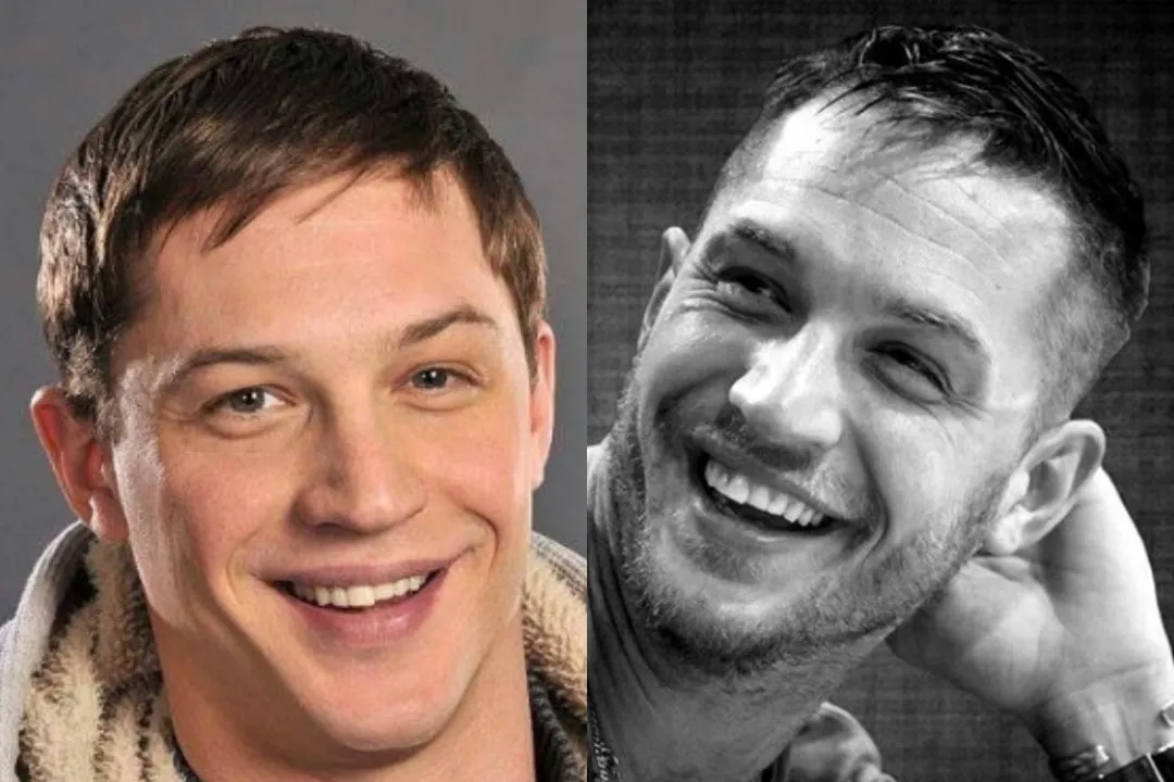 Tom Hardy's teeth before & after Antalya Gallery