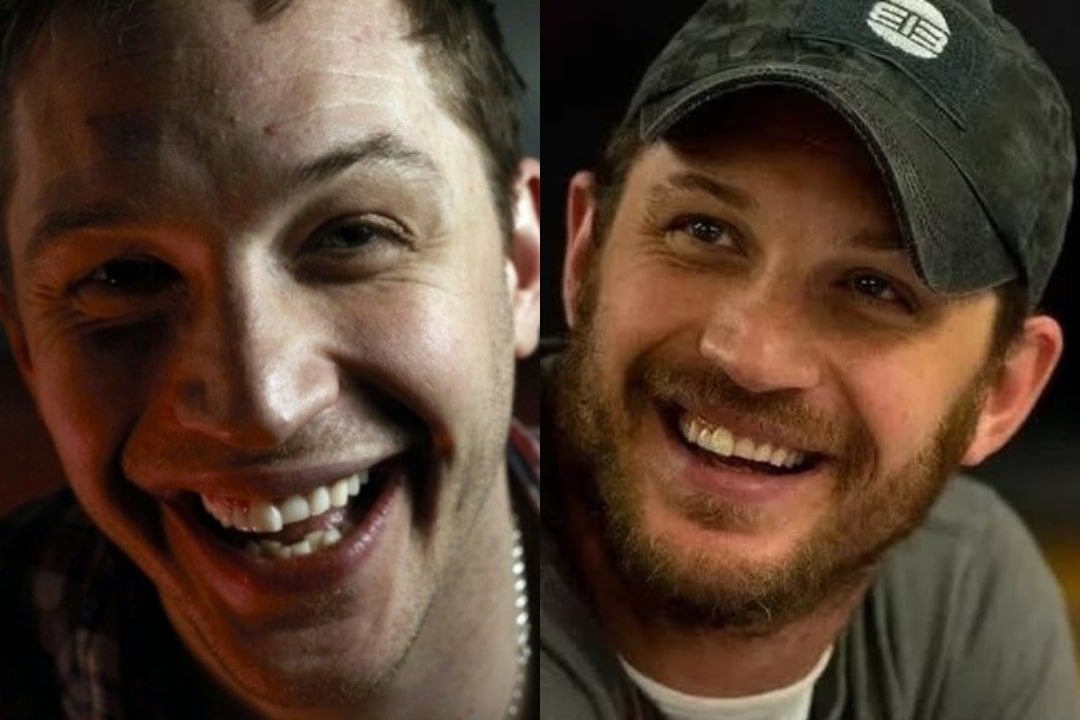 Tom Hardy's new teeth before & after