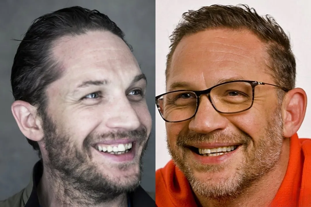 Tom Hardy's new teeth before & after