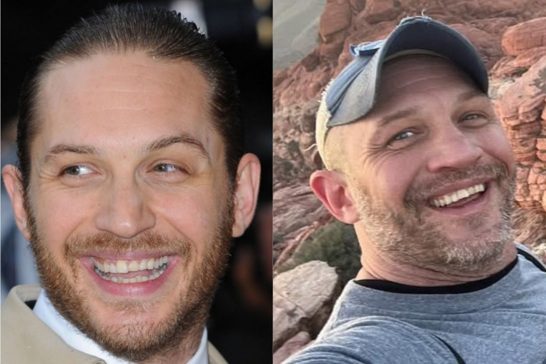 Tom Hardy's new teeth before & after