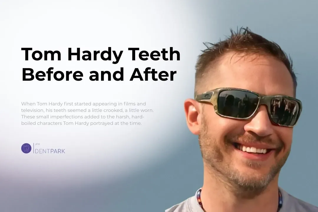 Tom Hardy Teeth Before and After