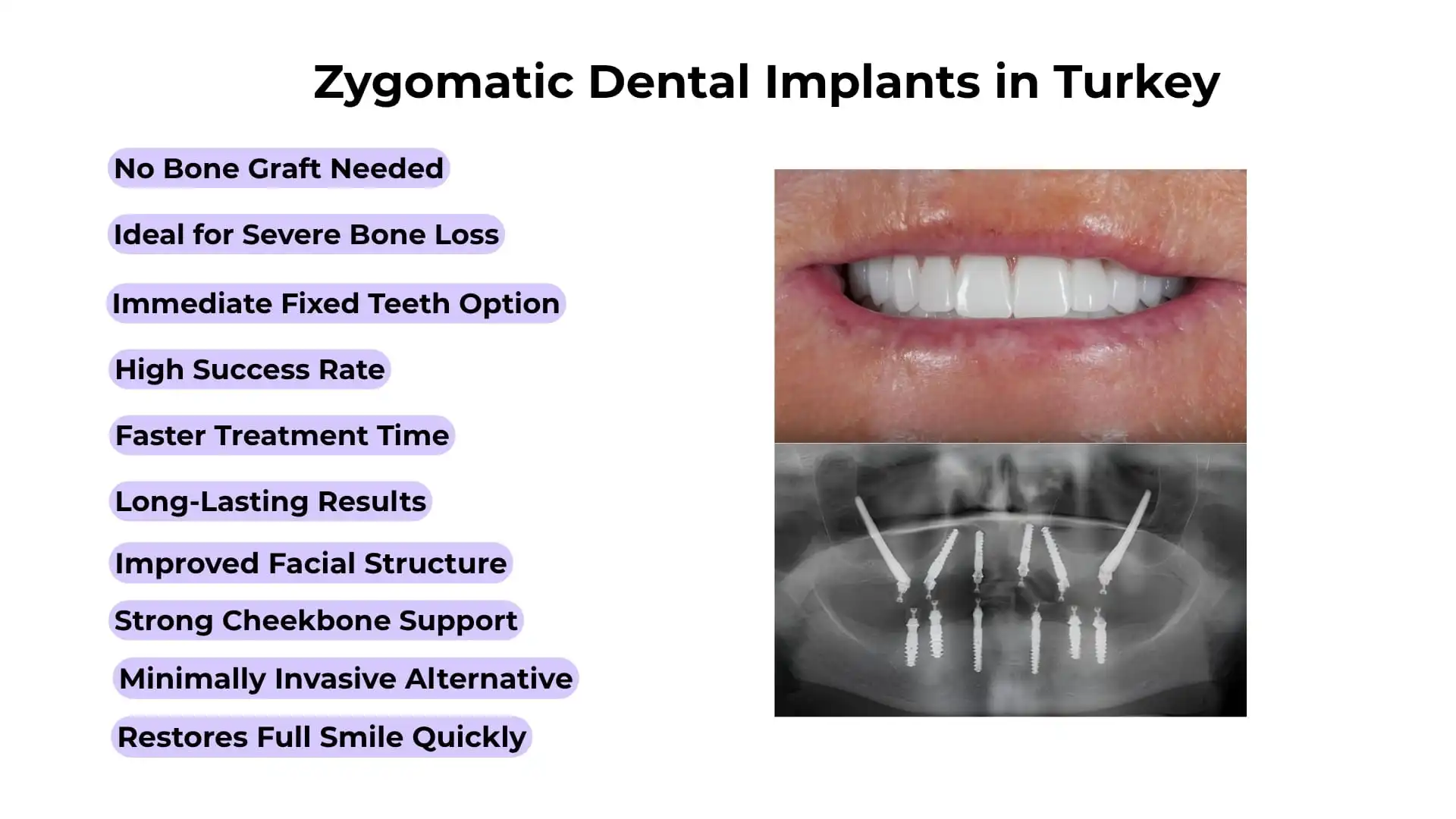 What are zygomatic dental implants in Turkey?