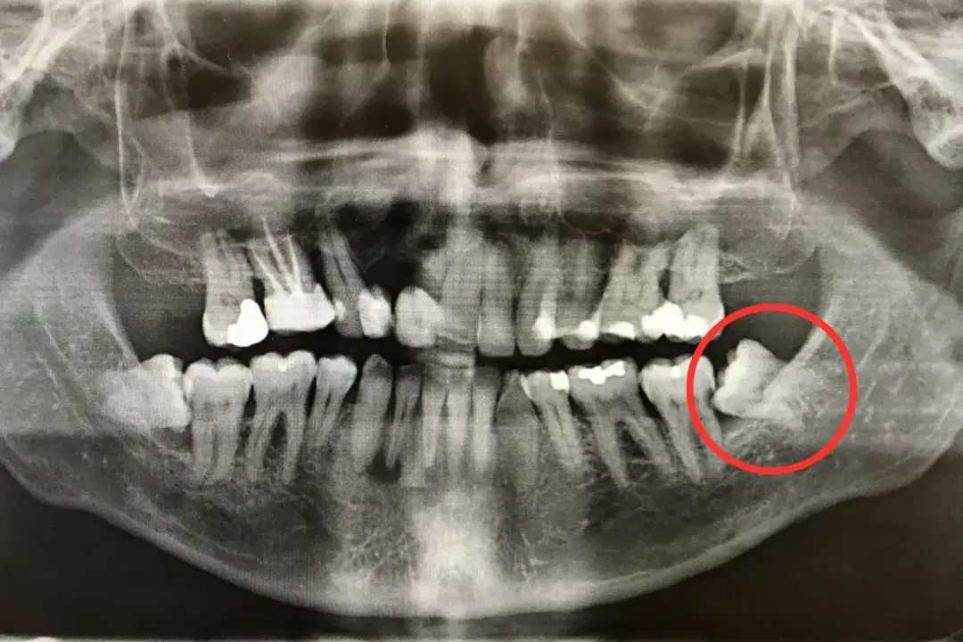 Why some experts now say not to remove your wisdom teeth
