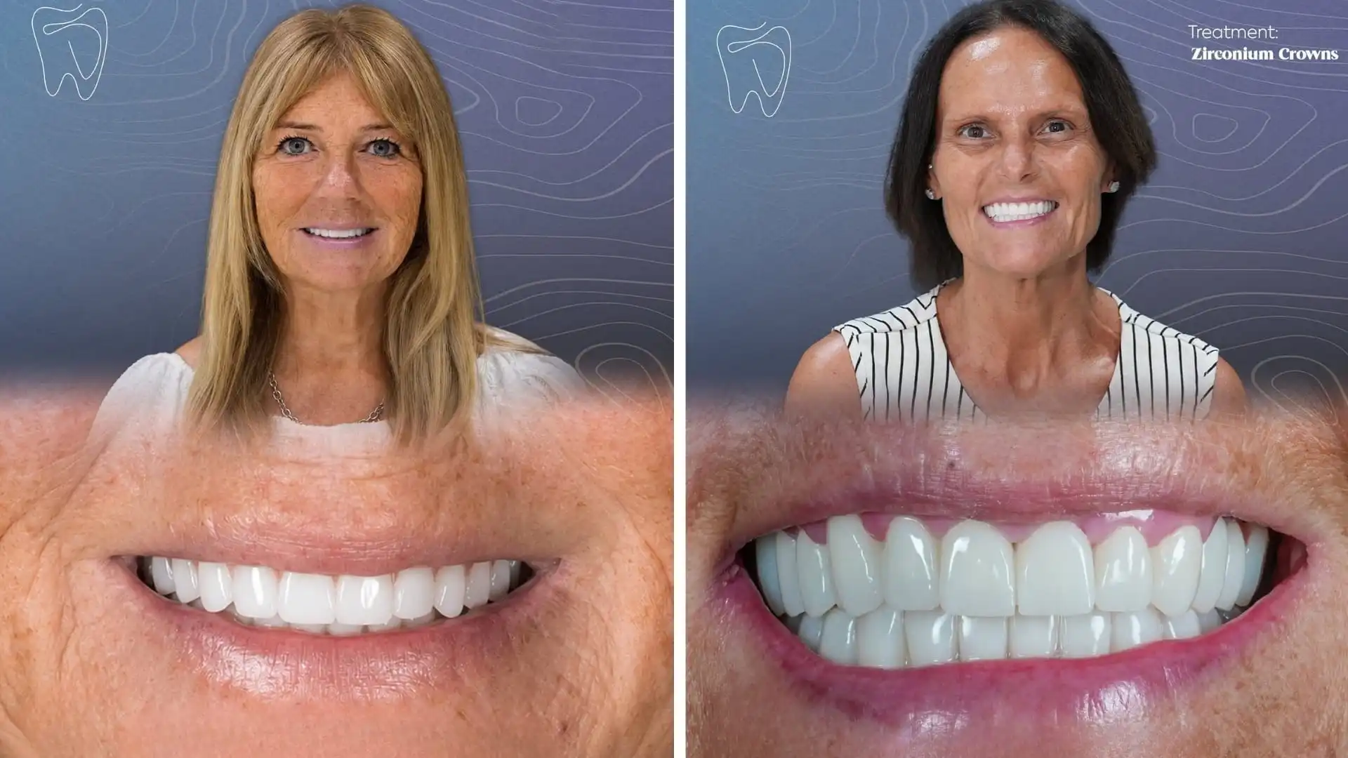  Zirconia crown before and after in Antalya, Turkey-1