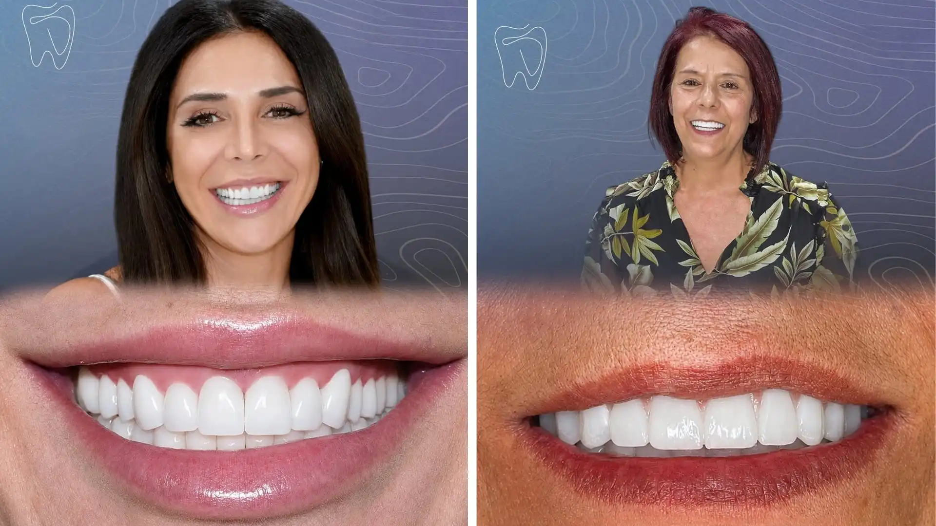 Zirconia crown before and after in Antalya, Turkey-2