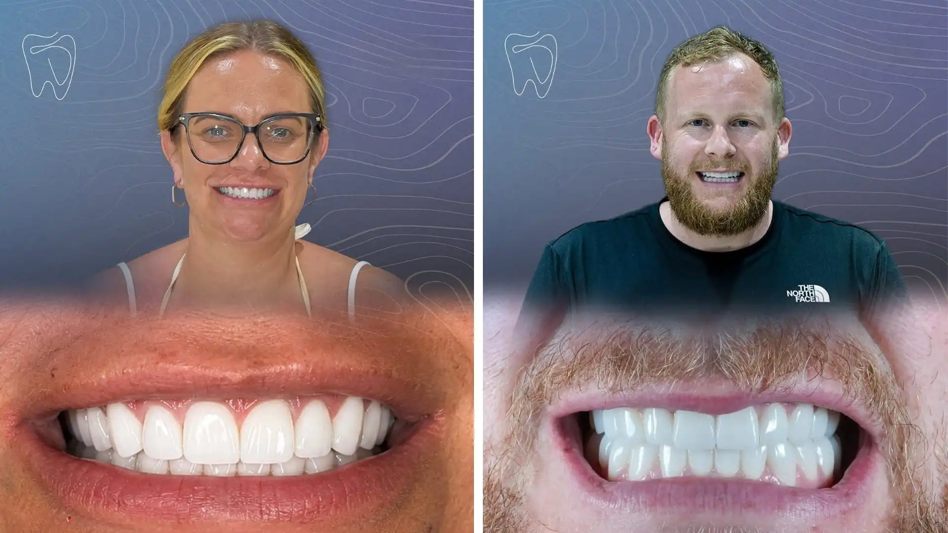 Zirconia crown before and after in Antalya, Turkey-3