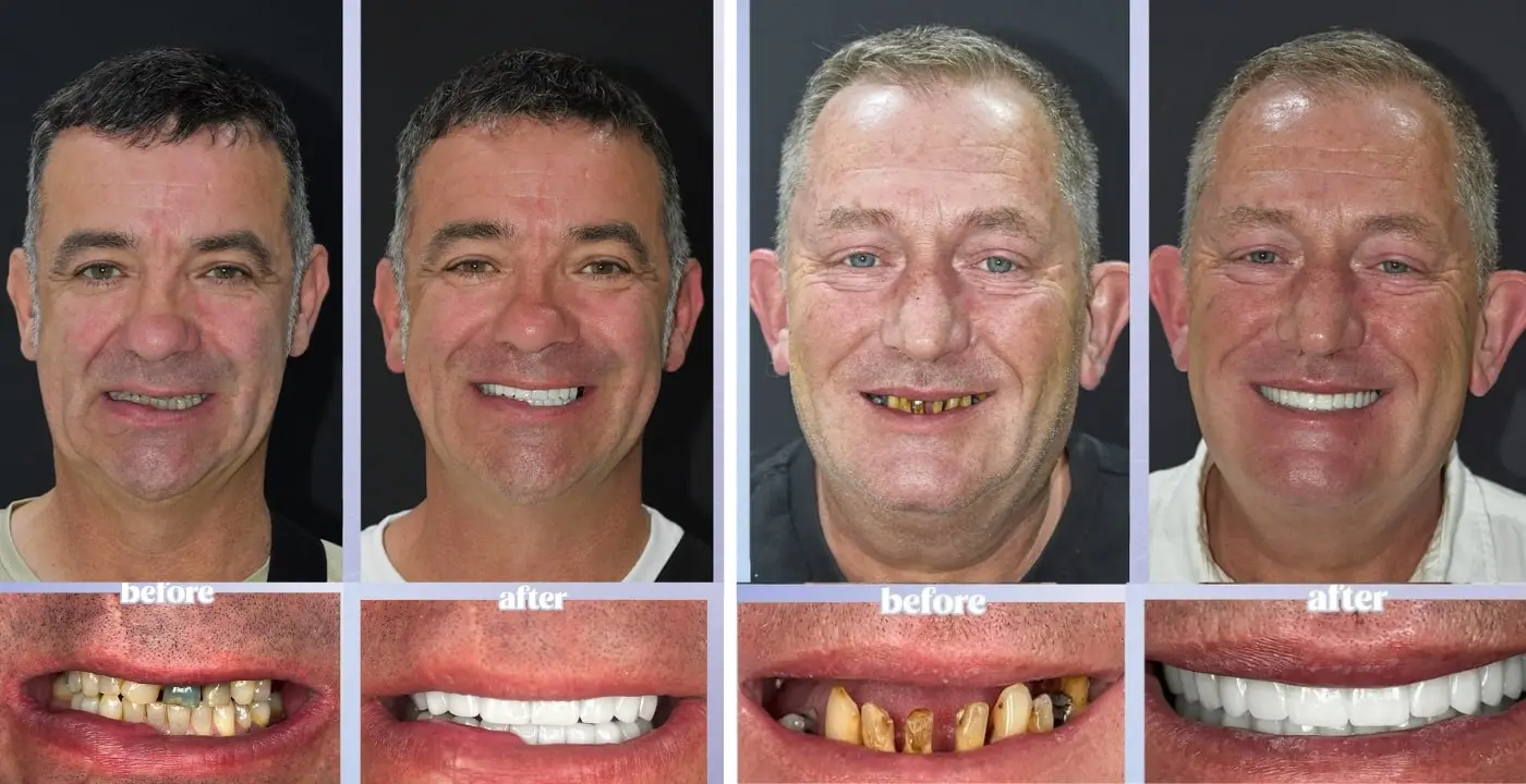 Zirconium crowns before after in Antalya, Turkey