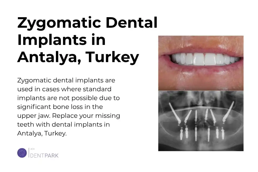 Zygomatic Dental Implants Antalya, Turkey Cost